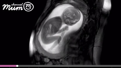 Ny MRI-scanning skaber debat om abortgrænsen